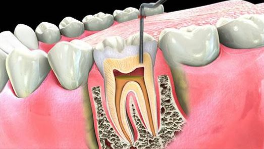 endodonti